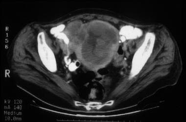 A 57-year-old woman with stage IVB poorly differen