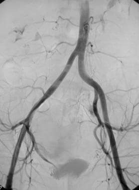 Nonselective angiogram of the pelvis after emboliz
