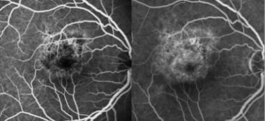 Acute retinal pigment epitheliitis: Early-phase fl