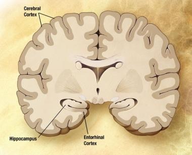 Preclinical Alzheimer disease. Image courtesy of N