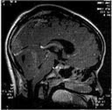 Cerebellar medulloblastoma. This sagittal view MRI