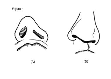 Cleft lip nasal deformity. A: Basal view. B: Front