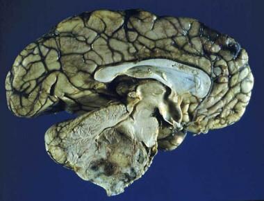 Sagittal section of an ependymoma of the fourth ve