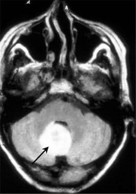 Brain abscess. Axial fluid-attenuated inversion re