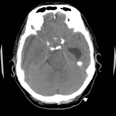 Nonenhanced head computed tomography (CT) scan obt
