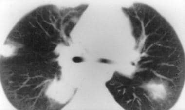 Granulomatosis with polyangiitis (GPA), thoracic. 