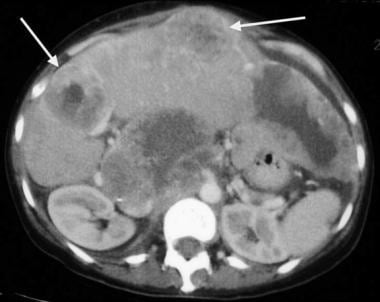 Small-bowel gastrointestinal stromal tumor with mu