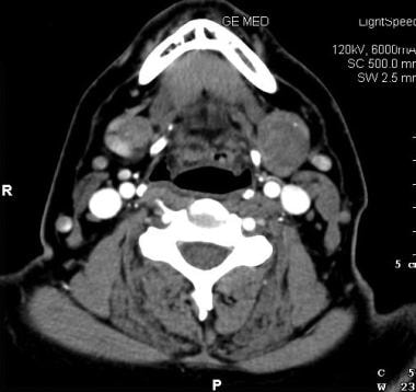 Axial contrast-enhanced CT scan demonstrates a poo