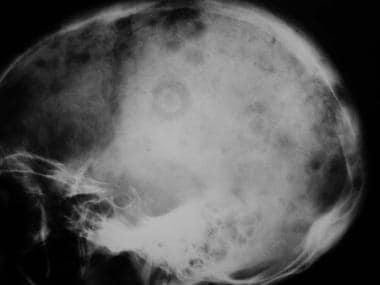 Lateral radiograph shows mixed osteolytic-scleroti