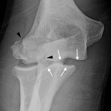 Elbow, fractures and dislocations. Unstable unicon
