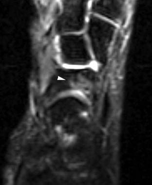 Axial T2-weighted image of the ankle demonstrates 