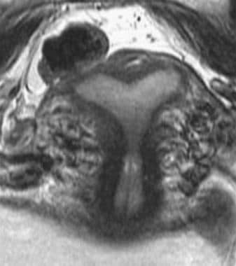 Uterus, müllerian duct abnormalities. MRI image of