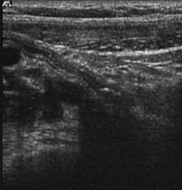 Typical sonographic appearance of a normal appendi