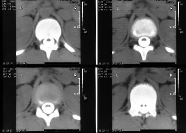 Axial CT scans through the upper lumbar spine show
