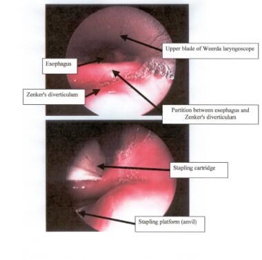 Endoscopic view of the partition between the esoph