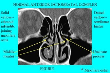 ct scan nasal cavity anatomy normal anterior sinus complex uncinate process infundibulum ethmoid anomalies sinusitis infection physiology medscape