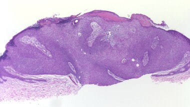 This juxtaepidermal poroma presents histopathologi