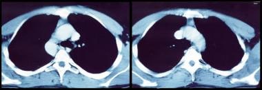 CT scan of chest and mediastinum showing thymoma i