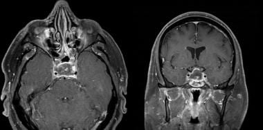 Enhanced T1-weighted axial and coronal MRI showing