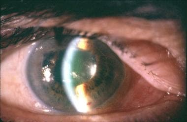 Malignant glaucoma subsequently developed in a 70-
