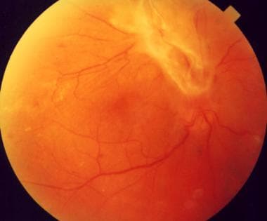 A patient with proliferative diabetic retinopathy 