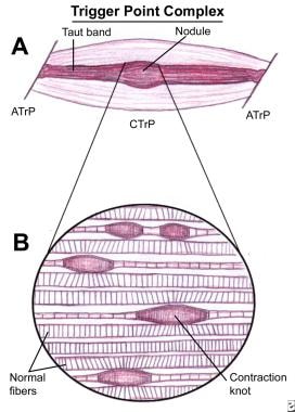 Schematic of a trigger point complex of a muscle i
