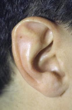 Stahl ear deformity with third crus. 