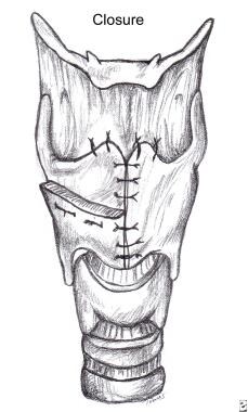 The laryngofissure is closed with 2-0 Prolene or 2