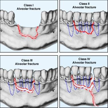 The various classes of alveolar fractures (per Cla