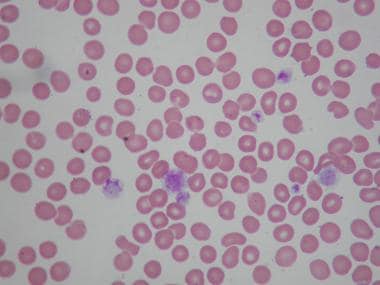 Peripheral smear of patient with Bernard-Soulier s