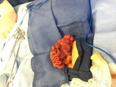 The peritoneal bands (Ladd bands) tethering the du