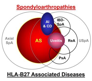 Family of spondyloarthropathies and HLA-B27 associ