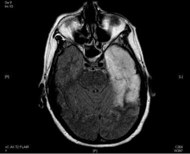 MRI axial FLAIR with gadolinium; herpes encephalit