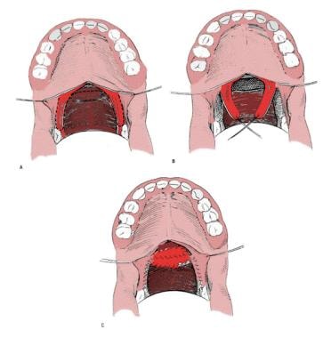 Sphincter pharyngoplasty. The palatopharyngeus mus