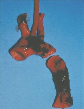 Aortic laceration. The typical location of an aort