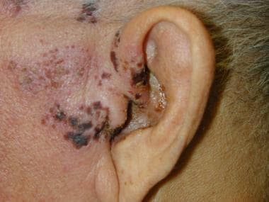 Herpes zoster oticus. Image courtesy of Manolette 