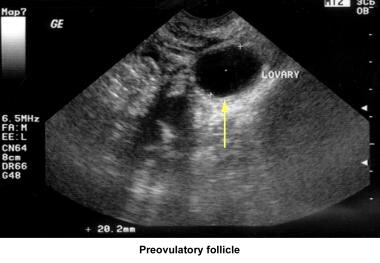 Infertility. Preovulatory follicle. Image courtesy