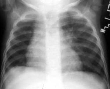 Anteroposterior chest radiograph of a 12-month-old