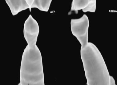 Granulomatosis with polyangiitis (GPA), thoracic. 