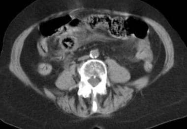 Mesenteric ischemia. CT scan in an 83-year-old wom
