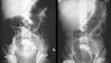 Ulcerative Colitis Imaging: Overview, Radiography, Computed Tomography