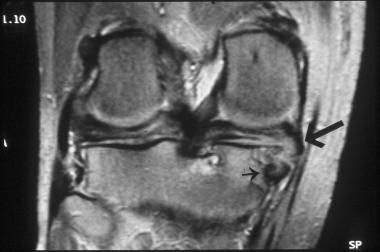 Meniscal Tear On Mri