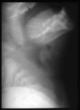 Lateral radiograph in a 2-year-old child with stri