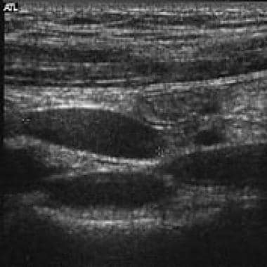 Typical sonographic appearance of a lymph node. 
