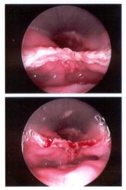 Endoscopic view of the stapled and cut edges of th