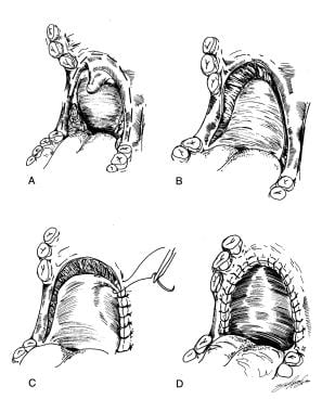 Uvulopalatopharyngoplasty. Reprinted with permissi