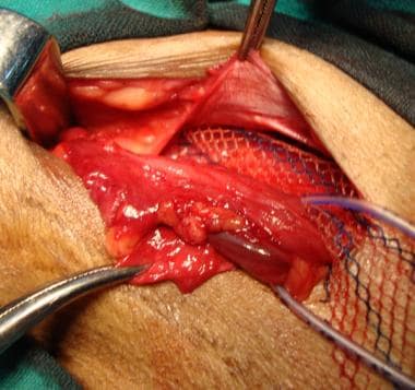 Open inguinal hernia repair. Wider upper tail of m