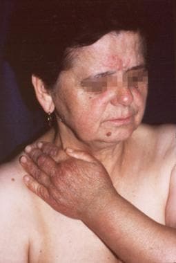 A 69-year-old woman. The initial lesion developed 