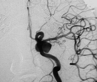 Cerebral angiogram (anteroposterior view) reveals