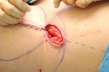 A Prolene suture is used to gather up the tissue e
